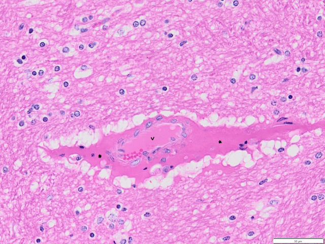 Histology of enterotoxaemia brain lesion. Histology of enterotoxaemia brain lesion.