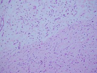 Relatively normal cerebral grey matter (bottom right) transitions to oedematous grey matter (top left) with infiltrating plump, round Gitter cells (phagocytic glial cells).